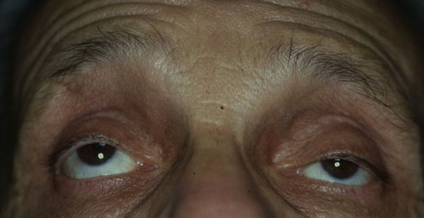 Figura 1 - Miastenia oculare: limitazione della motilità oculare estrinseca e ptosi palpebrale superiore (A). Si osservi il peggioramento della ptosi palpebrale superiore bilaterale dopo affaticamento muscolare (mantenimento dello sguardo verso l'alto per 60 sec) (B)
