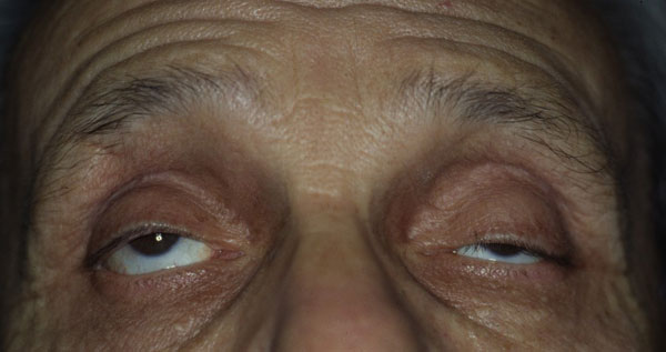 Figura 1 - Miastenia oculare: limitazione della motilità oculare estrinseca e ptosi palpebrale superiore (A). Si osservi il peggioramento della ptosi palpebrale superiore bilaterale dopo affaticamento muscolare (mantenimento dello sguardo verso l'alto per 60 sec) (B)