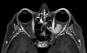 Figura 3 - RM con mezzo di contrasto che dimostra la presenza di glioma del nervo ottico sinistro