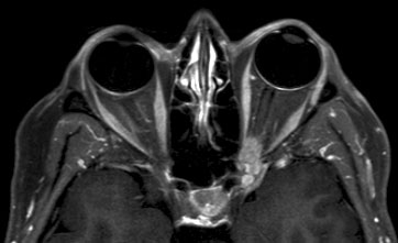 Figura 4 - RM con mezzo di contrasto che evidenzia la presenza di meningioma della guaina del nervo ottico di sinistra localizzato a livello intracanalicolare