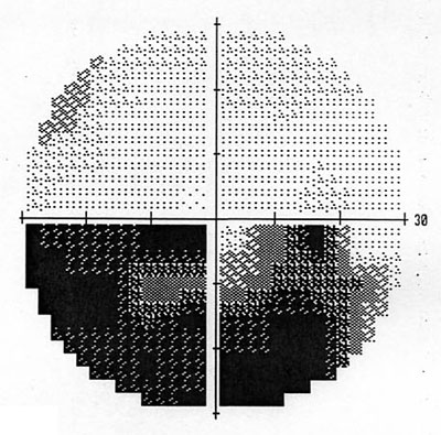 Figura 1 - Risultato dell'esame del campo visivo (perimetria automatizzata standardizzata Humphrey programma 30-2) che dimostra la presenza di un difetto altitudinale inferiore secondario a neuropatia ottica ischemica anteriore