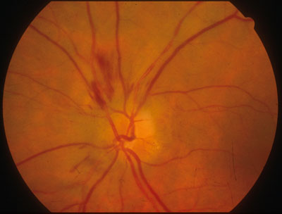 Figura 2 - L'immagine del fondo oculare che dimostra la presenza di edema del disco ottico associato ad emorragie a fiamma intraretiniche parapapillari; quadro clinico secondario a neuropatia ottica ischemica anteriore