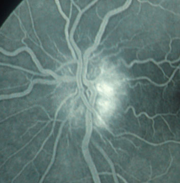 Figura 3 - Risultato dell'esame afluorangiografico del disco ottico in presenza di edema secondario a neuropatia ottica ischemica. Nelle fasi precoci dell'esame si osserva ipofluorescenza della porzione nasale ed iperfluorescenza della porzione temporale, che aumenta nelle fase pi tardiva