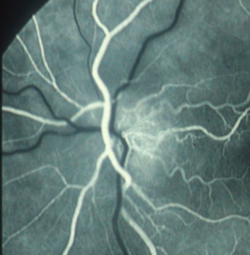 Figura 3 - Risultato dell'esame afluorangiografico del disco ottico in presenza di edema secondario a neuropatia ottica ischemica. Nelle fasi precoci dell'esame si osserva ipofluorescenza della porzione nasale ed iperfluorescenza della porzione temporale, che aumenta nelle fase più tardiva