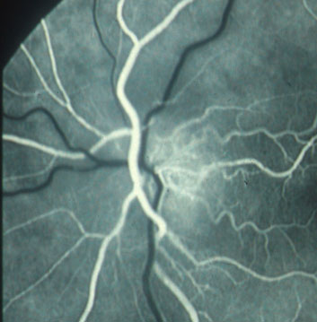 Figura 3 - Risultato dell'esame afluorangiografico del disco ottico in presenza di edema secondario a neuropatia ottica ischemica. Nelle fasi precoci dell'esame si osserva ipofluorescenza della porzione nasale ed iperfluorescenza della porzione temporale, che aumenta nelle fase pi tardiva