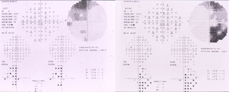 Figura 1 - Esame del campo visivo (perimetria automatizzata standardizzata Humphrey 30-2) che dimostra la presenza di un difetto bilaterale temporale secondario a compressione delle fibre chiasmatiche centrali (emianopsia bi temporale)