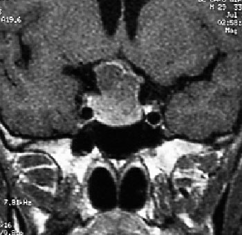 Figura 2 - Risonanza magnetica (RM) che dimostra la presenza di macroadenoma dell'ipofisi che comprime e disloca il chiasma ottico