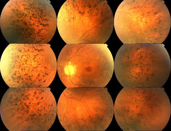 Figura 1 - Aspetto del fondo oculare secondario a retinopatia pigmentosa. Si osserva la presenza di depositi di pigmento nella periferia retinica; pallore del disco ottico e assottigliamento dei vasi arteriosi retinici