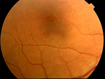 Figura 2 - Aspetto oftalmoscopico della superficie retinica secondario a distrofia dei coni. Si osserva la disomogeneità dell'aspetto della regione maculare perifoveale