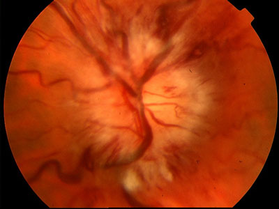 Figura 1 - Papilledema acuto. Si osserva la presenza di edema del disco ottico, di essudati cotonosi e di emorragie a fiamma a livello delle fibre nervose retiniche parapapillari