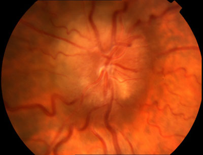 Figura 2 - Papilledema cronico. Si può osservare il sollevamento del disco ottico e l'edema delle fibre nervose. Non sono presenti essudati o emorragie intraretiniche parapapillari