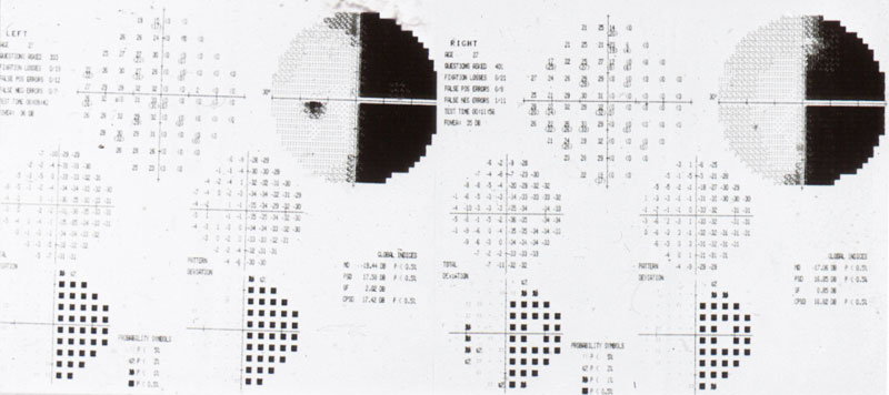 Figura 1 - Esame del campo visivo (perimetria automatizzata standardizzata Humphrey 30-2) che dimostra la presenza di un difetto bilaterale omonimo secondario a danno della radiazione ottica sx